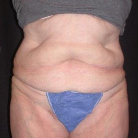 After image 1 Case #81861 - CoolSculpting