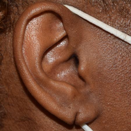 Before image 1 Case #107911 - Bilateral Earlobe Repair & Ear Piercing