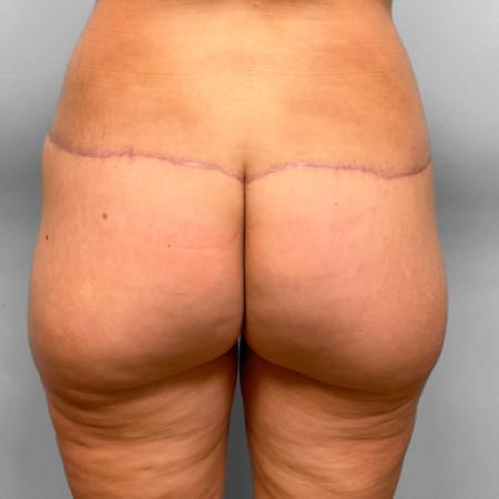 After image 1 Case #109276 - Butt Lift
