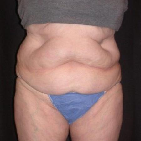 Before image 1 Case #81861 - CoolSculpting
